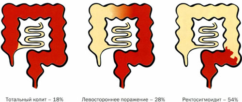 колит